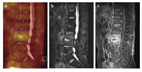 Osteomyelitis X Ray Spine