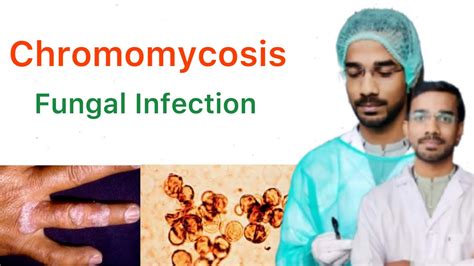 Chromomycosis | Sub-Cutaneous Mycosis - YouTube