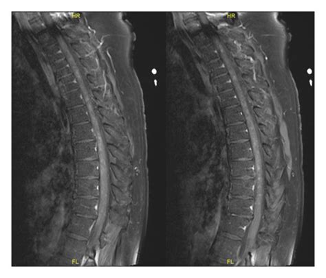 MRI spine T1-weighted sagittal images showing contrast enhancement ...