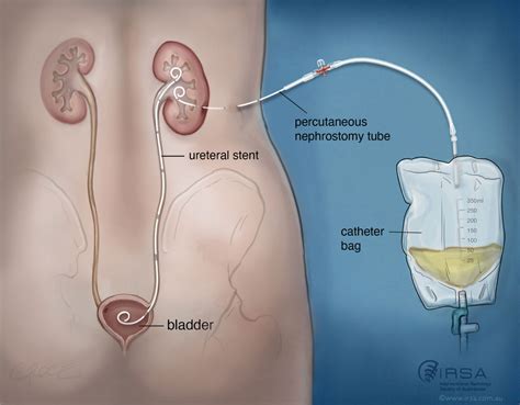 Nephrostomy Interventional Radiology Procedure For Kidney Care