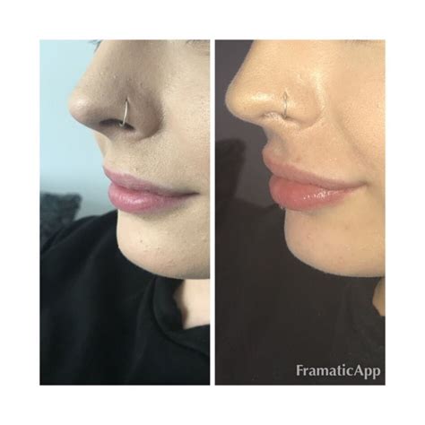 Before And After Photos Of Nose Lift With Rhinoplasty