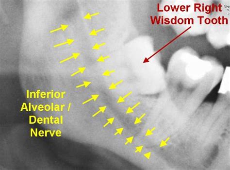 Dental Nerve Injuries Exodontia