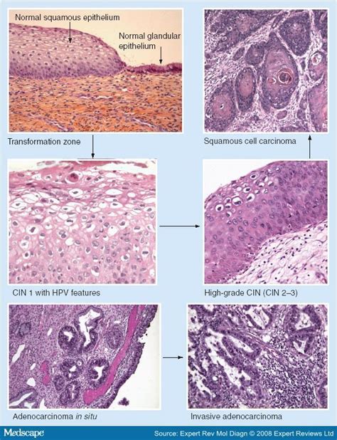 How To Describe Squamous Cell Carcinoma