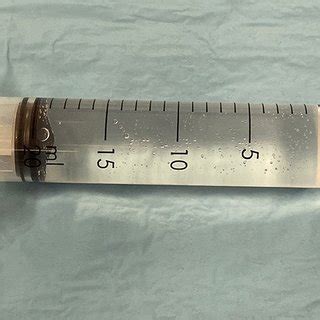 Visualization Of The Sacrouterine Ligaments By Pulling The Cervix