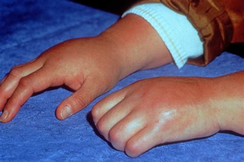 Reflex Sympathetic Dystrophy Rsd