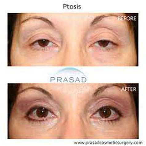 What Causes Ptosis Medizzy