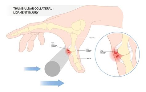 Radial Collateral Ligament Thumb Pain