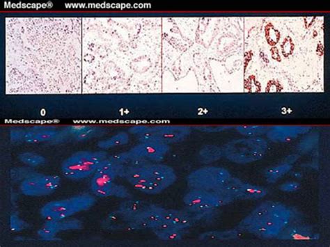 HER2-positive testing (a) by IHC (courtesy of Dc M. J. Kornstein ...