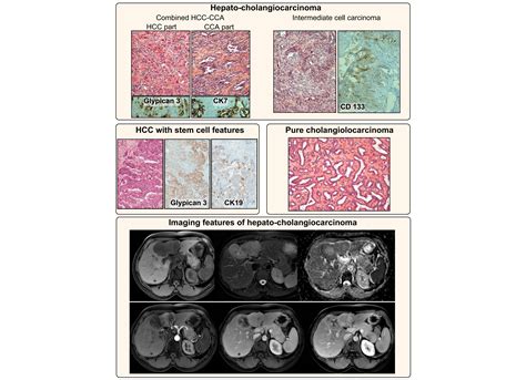 New Insights Into The Pathophysiology And Clinical Care Of Rare Primary Liver Cancers Jhep Reports