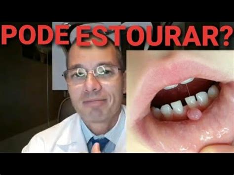 BOLHA NO LÁBIO MUCOCELE precisa de CIRURGIA Pode ESTOURAR YouTube