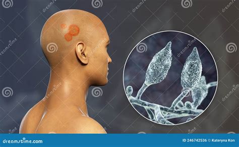 Fungal Infection on a Man S Head, 3D Illustration Stock Illustration ...