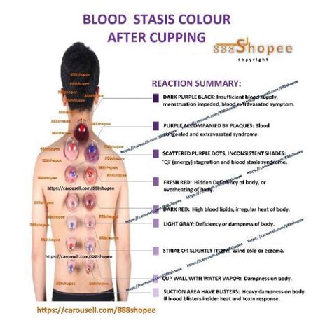 Pin On Quick Saves Cupping Points Cupping Therapy Cupping Treatment