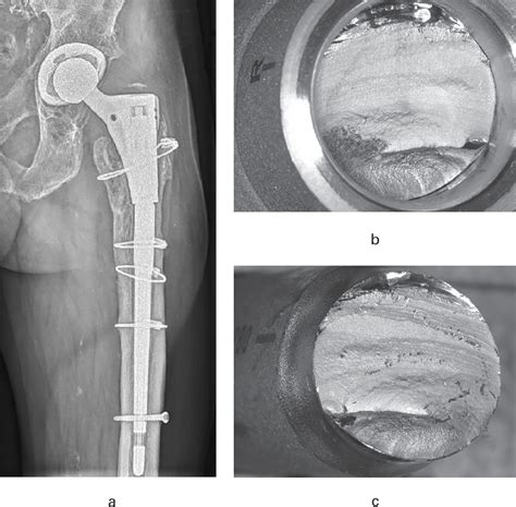 Analysis Of Modular Taper Fractures Of The Revision Hip Stem Prevision