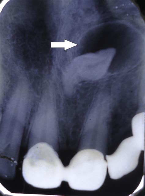 Radiograph Showing An Impacted Inverted And Dilacerated Mesodense With