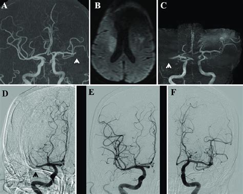 A Three Dimensional Ct Angiography Of The Intracranial Lesion Revealed