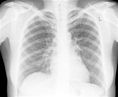 FindaTopDoc Blog: Symptoms of Walking Pneumonia