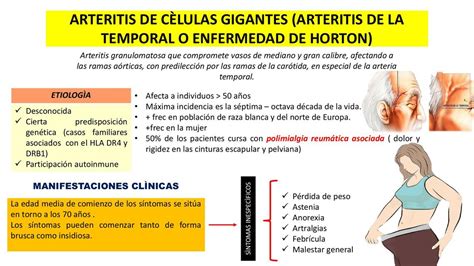 Arteritis De La Temporal KIARA GIANELLA VERA SALHUANA UDocz