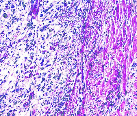 Dermatofibrosarcoma Pathology Outlines