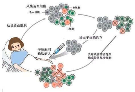 多发性骨髓瘤与造血干细胞移植 科普知识 血液肿瘤中心 科室导航 重庆大学附属肿瘤医院重庆市肿瘤医院【官方网站】