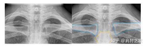 带您了解肩部脱位之胸锁脱位 知乎