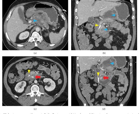 Figure From Hemosuccus Pancreaticus A Rare Bleeding Pseudoaneurysm