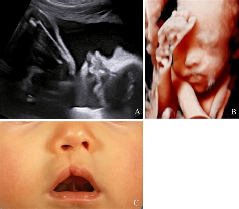 Unilateral Cleft Lip Visualized On Ultrasound During The Prenatal