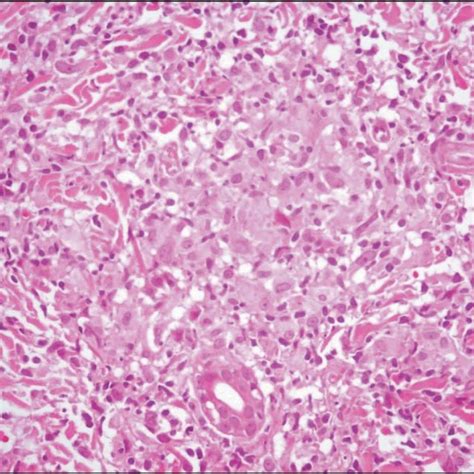 High Power Histologic Examination Of Skin Punch Biopsy Exhibiting