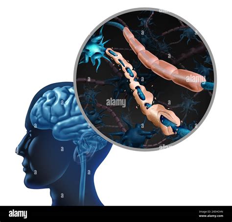 Multiple Sclerosis Disease Nerve Disorder And Damaged Myelin Or Ms Autoimmune With Healthy Nerve