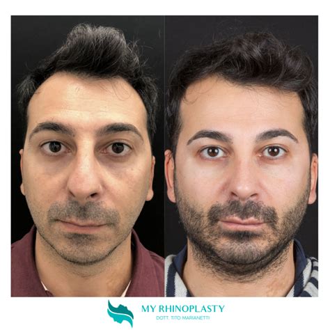 Cartilagine Alare Naso Gonfia Cosa Fare My Rhinoplasty