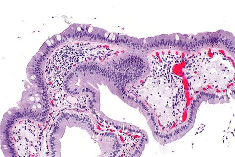 Intestinal Metaplasia Of The Gallbladder Libre Pathology