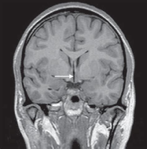 Coronal T Weighted View Demonstrating Cavum Septum Pellucidum Arrow