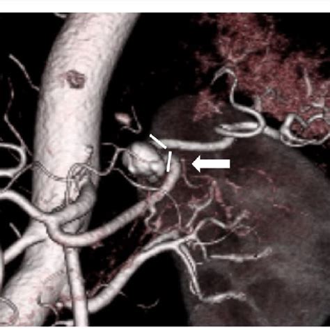 Preoperative Enhanced Computed Tomography Enhanced Computed Tomography Download Scientific