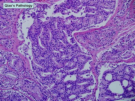 Prostate Adenocarcinoma Histology