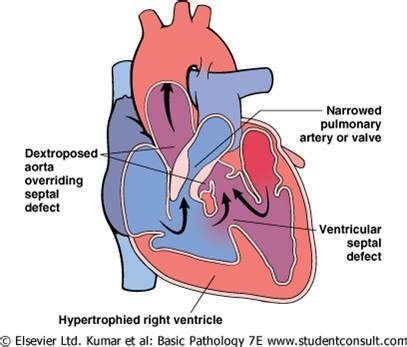 UNF NAP Congenital Heart Disease Peds Flashcards Quizlet