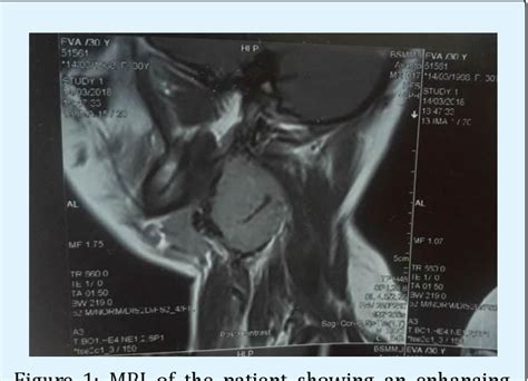 Figure 1 from Management of Paragangliomas in Neck-A Case Report | Semantic Scholar