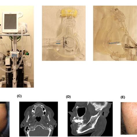 A Ventilator And Fullface Mask Of Noninvasive Positive Pressure