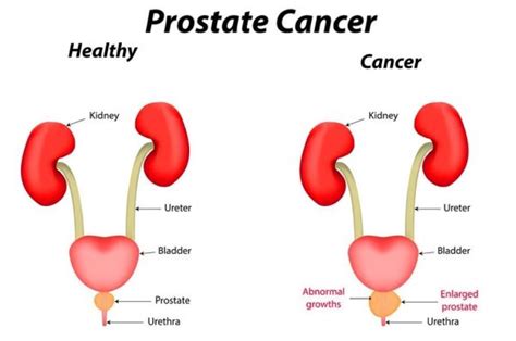 Prostate Cancer Symptoms Diagnosis And Treatment Options Dr