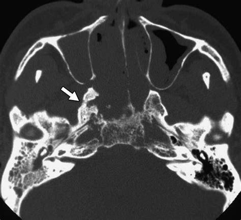 MRI And CT Of Nasopharyngeal Carcinoma AJR