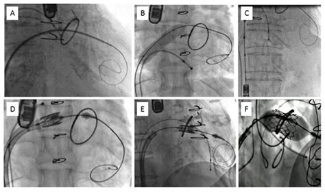 Potential And Challenges Of Transcatheter Mitral Valve Implantation