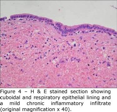 Nasopalatine Duct Cyst Histology