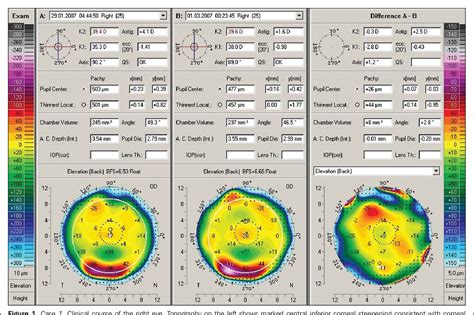 Figure 1 From Management Of Corneal Ectasia After Lasik With Combined