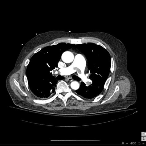 Pulmonary embolism case studies - wikidoc