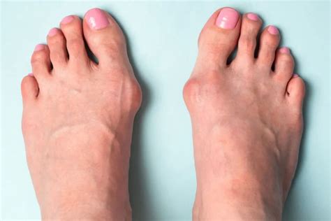 How To Get Rid Of Bunions On Foot