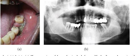 Figure 1 From Rapidly Progressing Osteomyelitis Of The Mandible Semantic Scholar