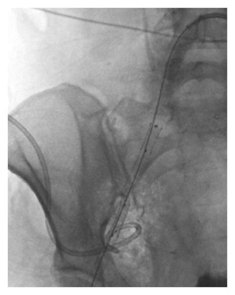 Fluoroscopic Spot Image Demonstrates Covered Stents Deployed Across