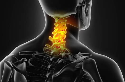 Cervical Disc Disorder