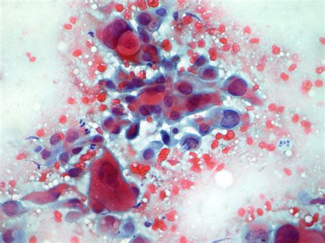 Lung Cytopathology