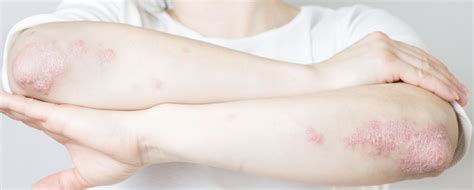 Take Control of Psoriasis and Uncover the Most Common Causes ...