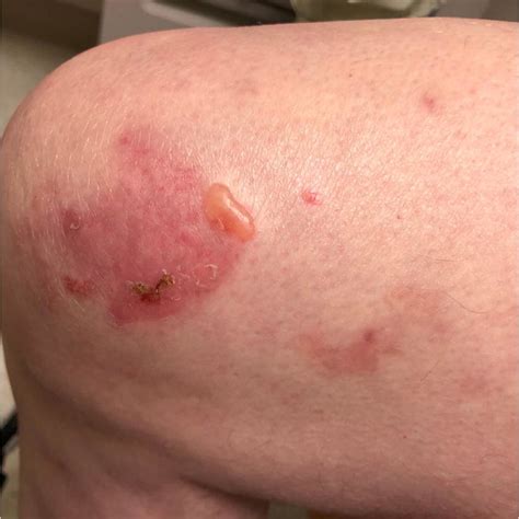 Bullous Pemphigoid Induced By Atezolizumab Manifesting As Tense Bullae