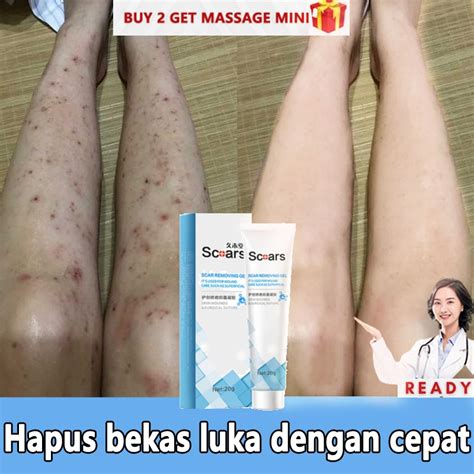 Jual Penghilang Bekas Luka Menghilangkan Bekas Jerawat Stretch Mark